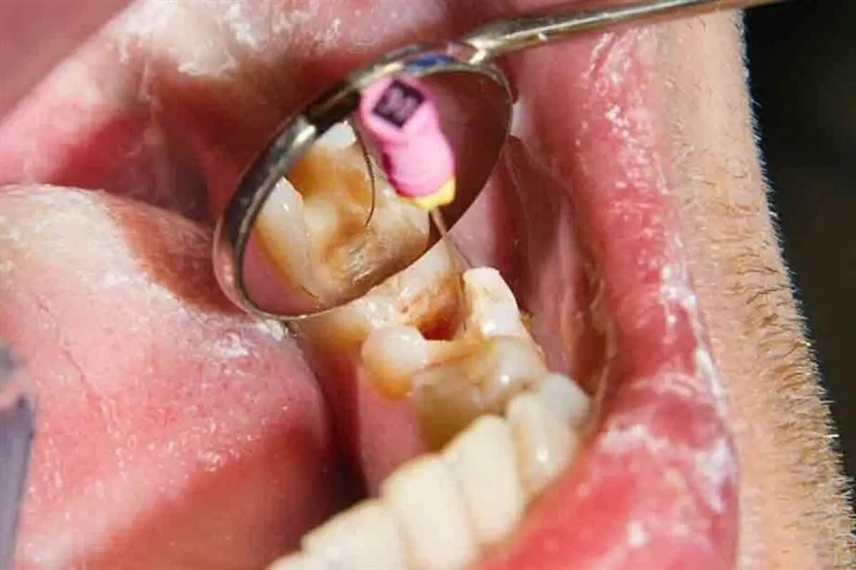 آغاز ارائه خدمات عصبکشی دندان با تعرفه دولتی در مراکز منتخب